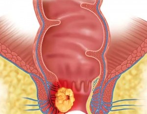 Парапроктит, исцеление без скальпеля